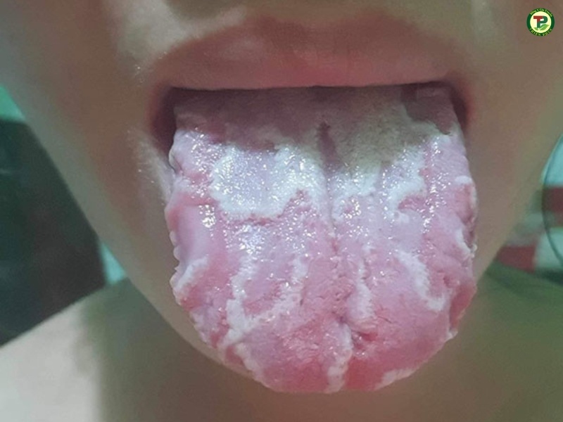 Nấm và khuẩn hoạt động mạnh gây ra viêm lưỡi bản đồ